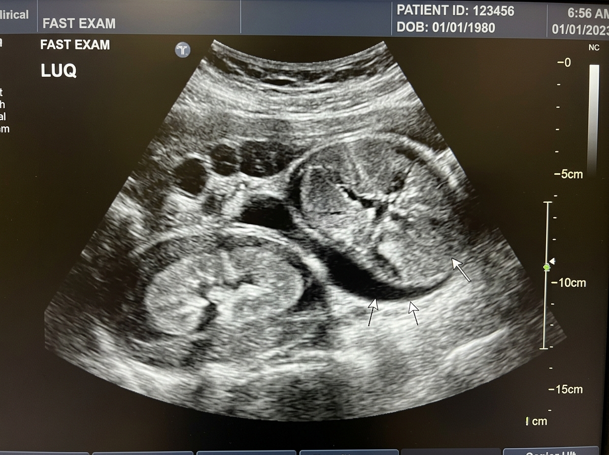 FAST Ultrasound Splenic Rupture Splenorenal Recess Hemoperitoneum