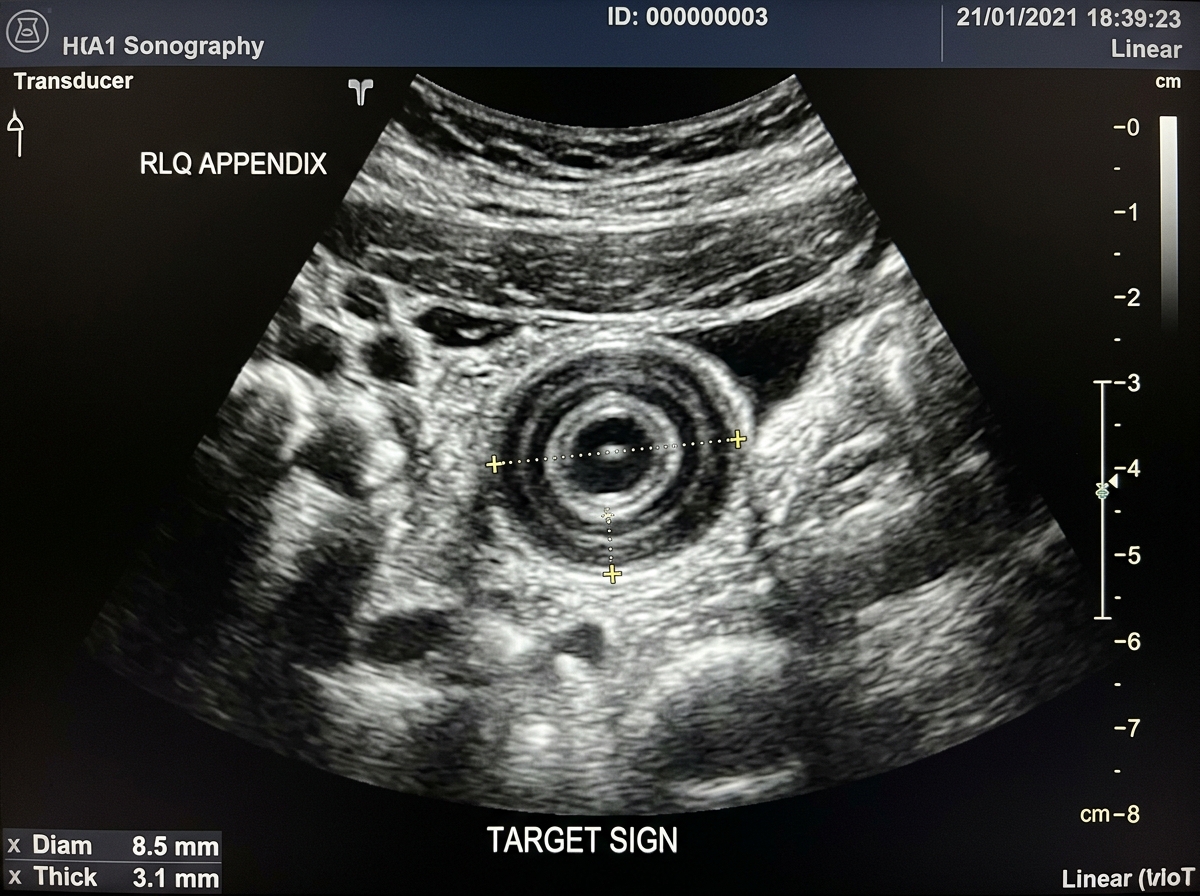 Right Iliac Fossa Ultrasound Acute Appendicitis Target Sign